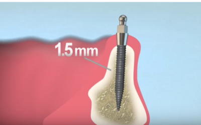 Mini implantátum, fogászati implantátumok méretei