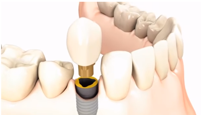 A fogimplantátum kilökődés tünetei és okai - Dentpoint